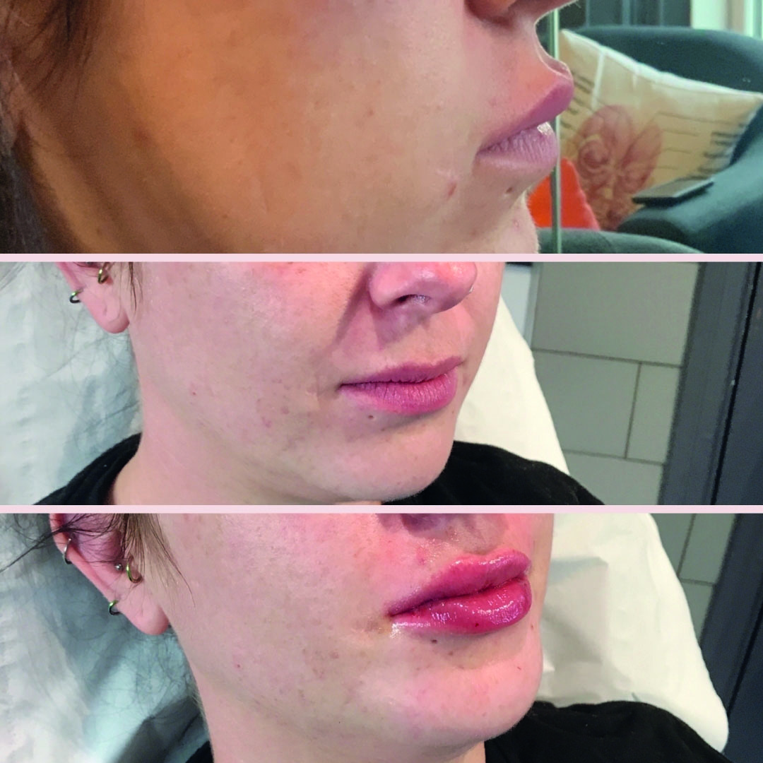 lip-filler-dissolving-and-re-injecting-after-lockdown